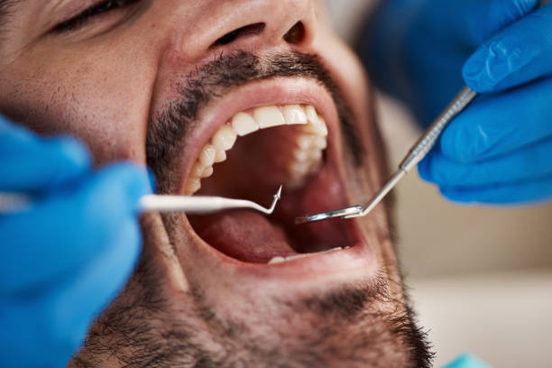 Best Emergency Tooth Extraction in Morgantown, IN