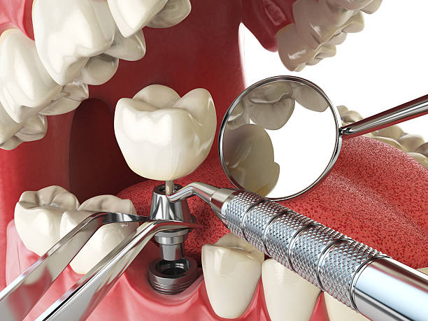 Best Emergency Tooth Extraction in Morgantown, IN